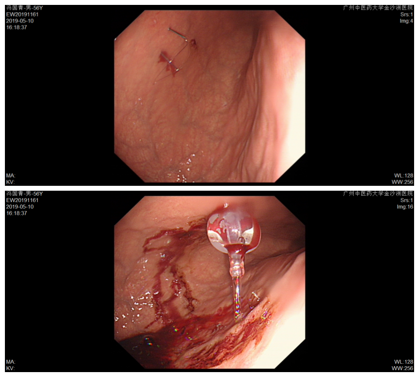 【技术济世】告别胃管，吞咽困难患者的新选择！