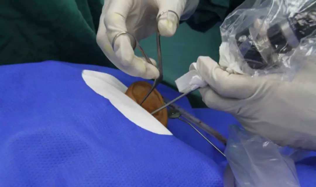 【技术济世】耳内镜技术-----耳科疾病患者的福音