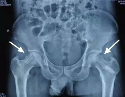 为什么有的人年纪轻轻，却患上股骨头坏死？