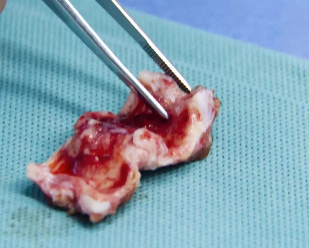 反复辗转求医，金沙洲医院胸外科妙手治愈顽疾！