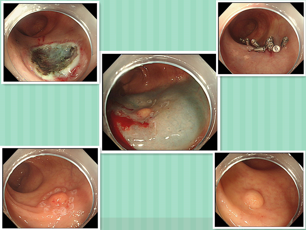 我院成功施行内镜粘膜下剥离术（ESD），再创学术新高！