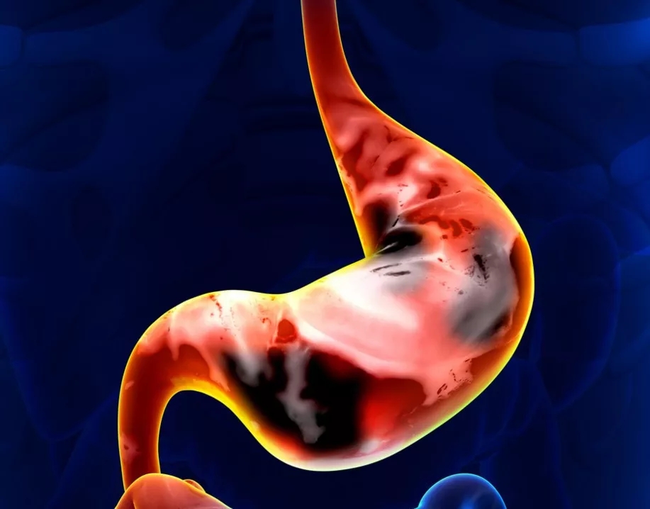 我院成功施行内镜粘膜下剥离术（ESD），再创学术新高！