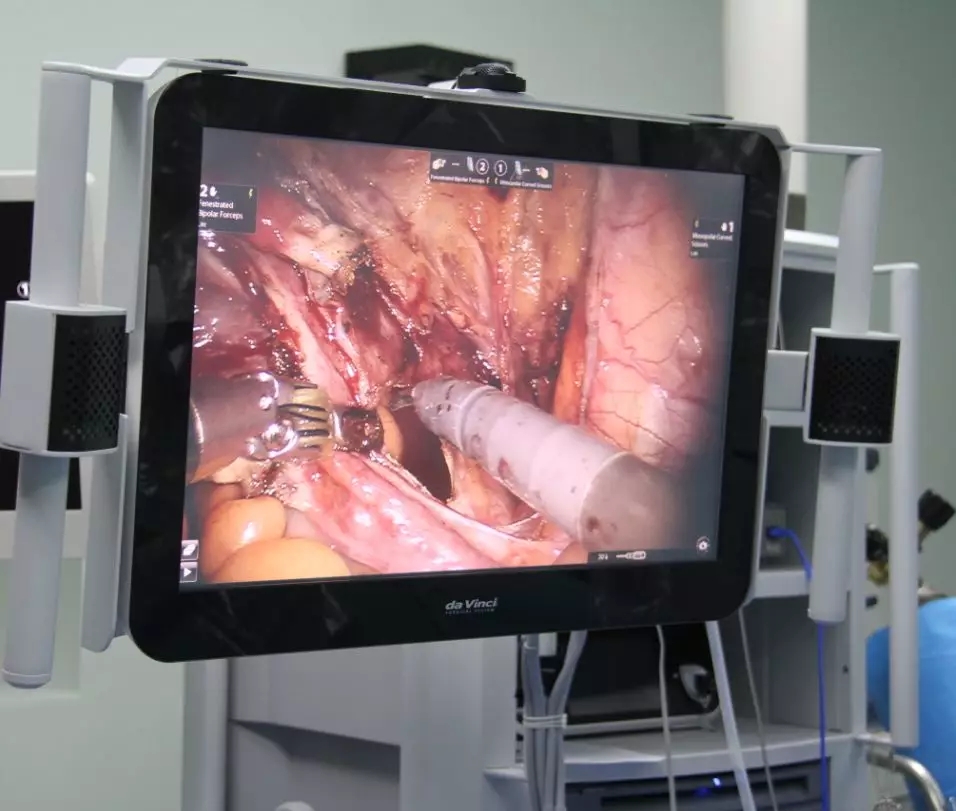 金沙洲医院成功开展首台达芬奇机器人手术，跨入“机器人时代”！